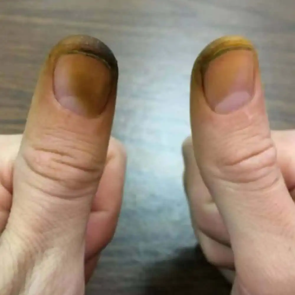 پاک کردن رنگ گردو از دست